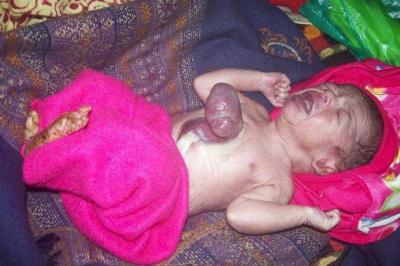 بالصور.. طفل هندي يولد بقلب بارز