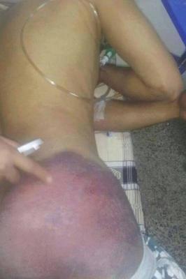 شاهد بالصور: كيف عذبت جماعة الحوثي أحد الناشطين بصنعاء